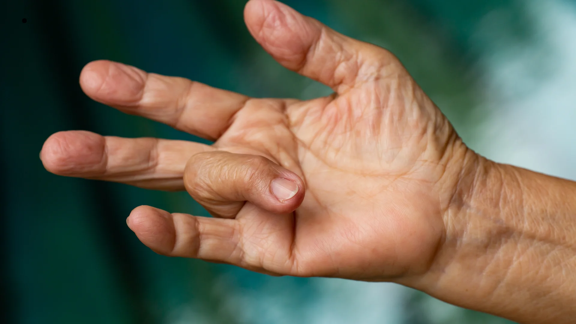 Trigger Finger Release | Orthopaedic Surgery | Ortho ARC | Dr Blake Fidock